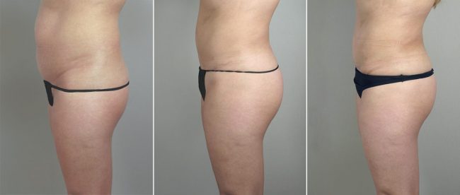 brazilian-butt-lift-TRIPLE-7-years-post