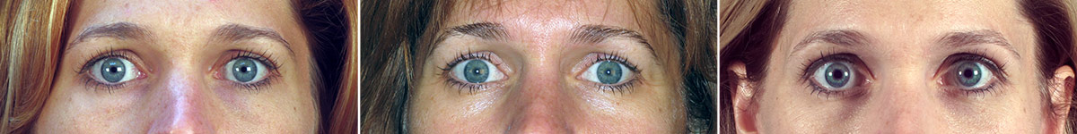 eyes-52-lower-lid-bleph-triple-2005-2007-2014