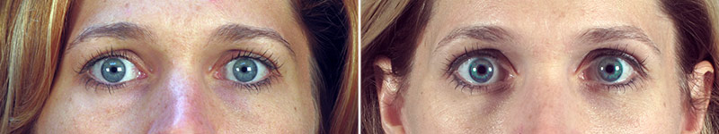 Lower Eyelid Lift Patient 12