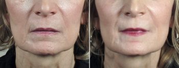 Angela’s Patient 16 – Restylane