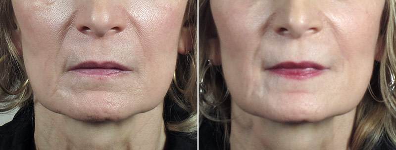 Angela’s Patient 16 – Restylane