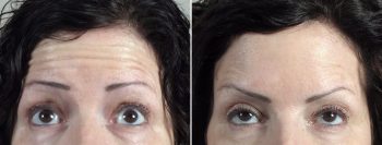 Angela’s Patient 17 – Dysport