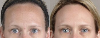 Angela’s Patient 18 – Dysport