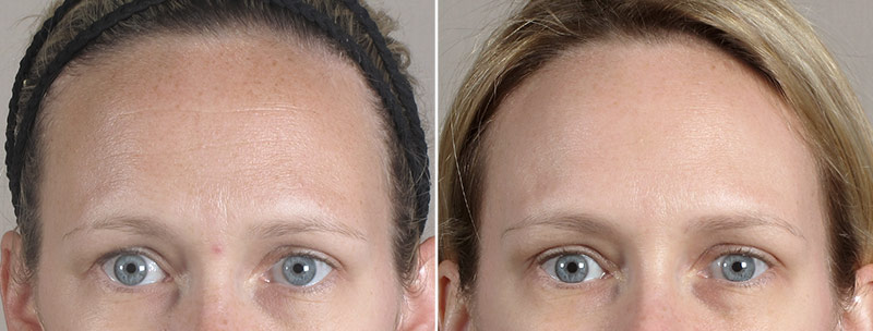 Angela’s Patient 18 – Dysport