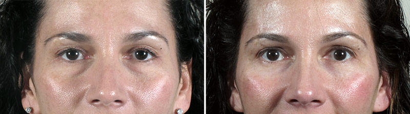 Lower Eyelid Lift Patient 13