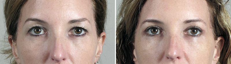Upper Eyelid Lift Patient 20