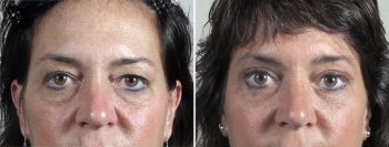 Browlift & Eyelid lift Patient 55