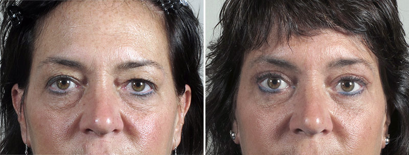 Browlift & Eyelid lift Patient 55