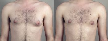 Gynecomastia Reduction Patient 49