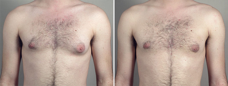 Gynecomastia Reduction Patient 49