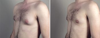 Gynecomastia Reduction Patient 49