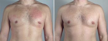 Gynecomastia Reduction Patient 50