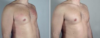 Gynecomastia Reduction Patient 50