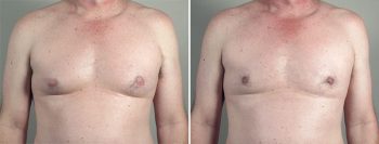 Gynecomastia Reduction Patient 51