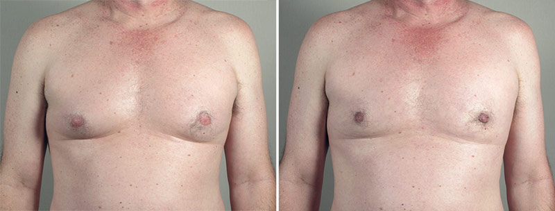 Gynecomastia Reduction Patient 51