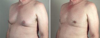 Gynecomastia Reduction Patient 51