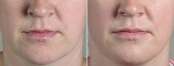 Lip Enhancement Patient 11