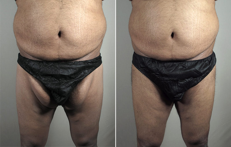 Male Inner Thigh Lift Patient 1