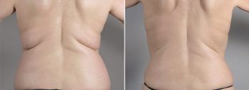 CoolSculpting Patient 03