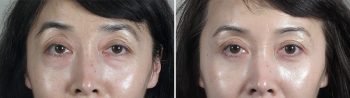 Lower Eyelid Lift Patient 14