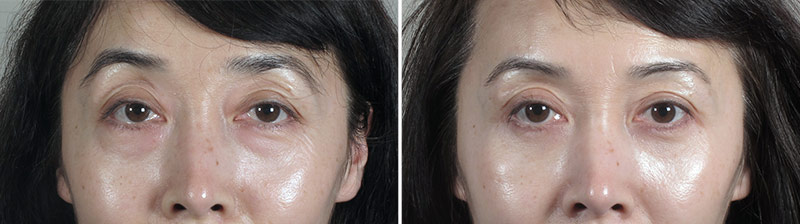Lower Eyelid Lift Patient 14
