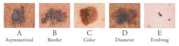 Blog Image for Could This Be Skin Cancer?
