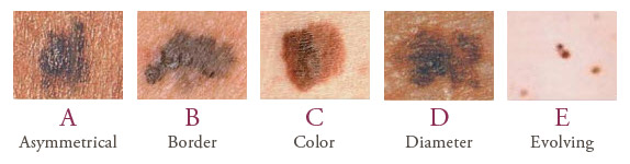 parker-abcde-skin-cancer