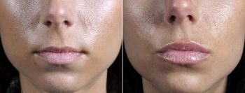 Angela’s Patient 19 – Fillers