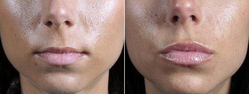 Angela’s Patient 19 – Fillers