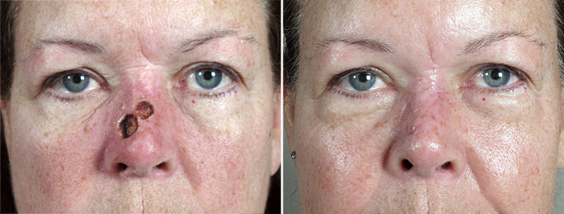 Skin Cancer Treatment Patient 46