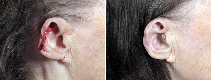 Skin Cancer Treatment Patient 47