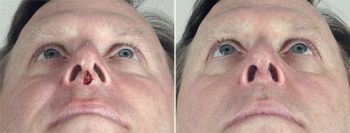 Skin Cancer Treatment Patient 49