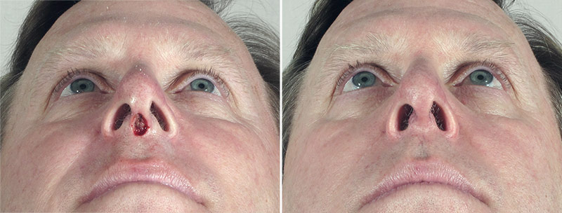 Skin Cancer Treatment Patient 49