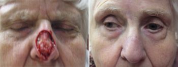 Skin Cancer Treatment Patient 50