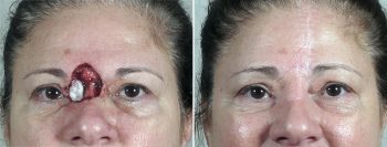 Skin Cancer Treatment Patient 51