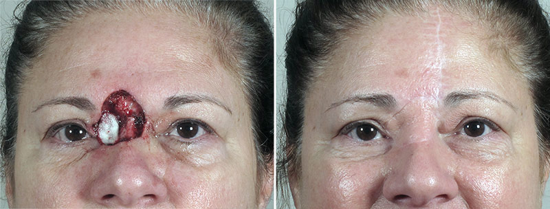 Skin Cancer Treatment Patient 51