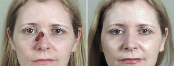 Skin Cancer Treatment Patient 52