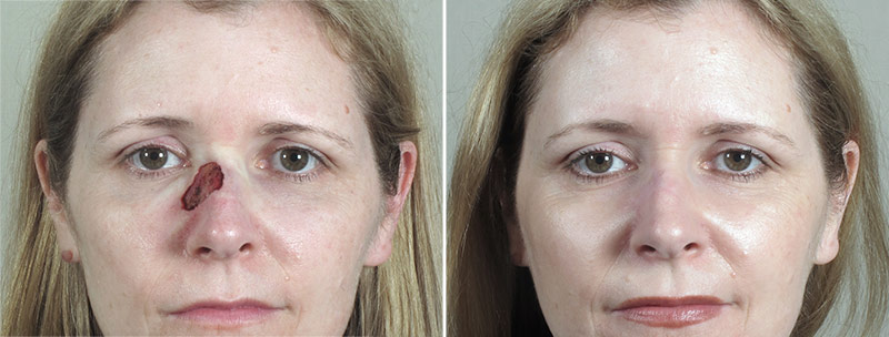 Skin Cancer Treatment Patient 52