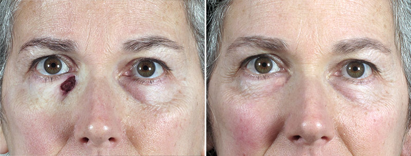 Skin Cancer Treatment Patient 53