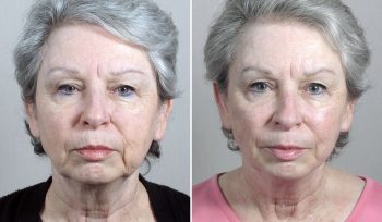 Mini Facelift Patient 38