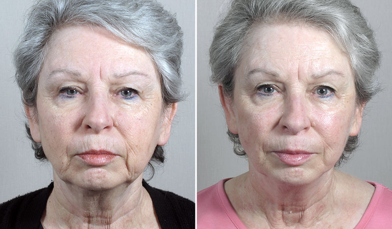 Mini Facelift Patient 38