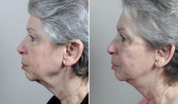 Mini Facelift Patient 38