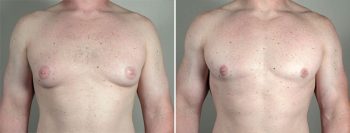 Gynecomastia Reduction Patient 52
