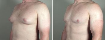 Gynecomastia Reduction Patient 52
