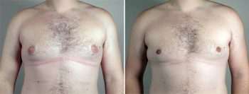 Gynecomastia Reduction Patient 53