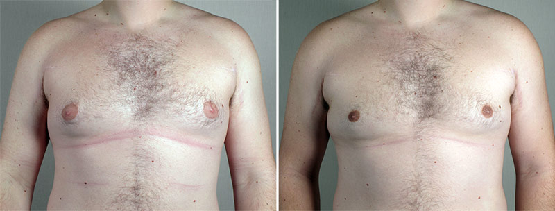 Gynecomastia Reduction Patient 53