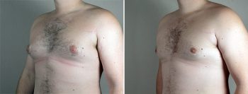 Gynecomastia Reduction Patient 53