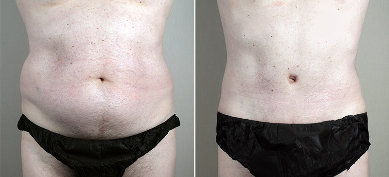 Male Abdominoplasty Patient 11
