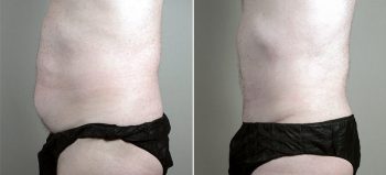 Male Abdominoplasty Patient 11