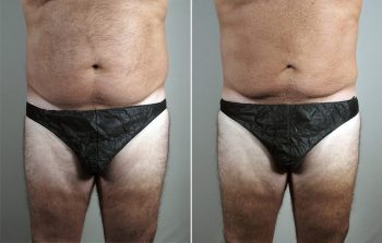 Male Liposuction Patient 26